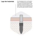 Implantat 0° D 3,0 x L 07 mm